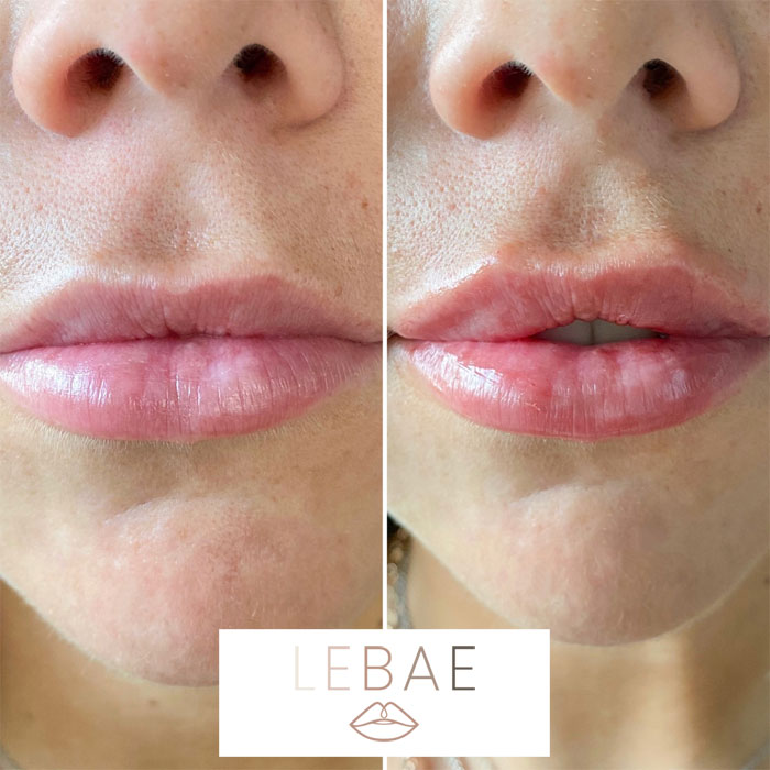 Before and after photos of lip fillers frontal view